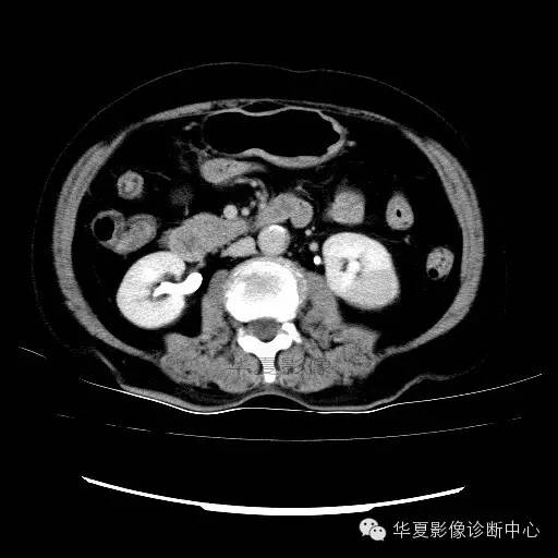 【病例】肾孟癌1例