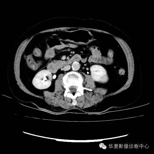 【病例】肾孟癌1例