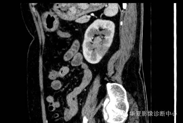 【病例】肾孟癌1例