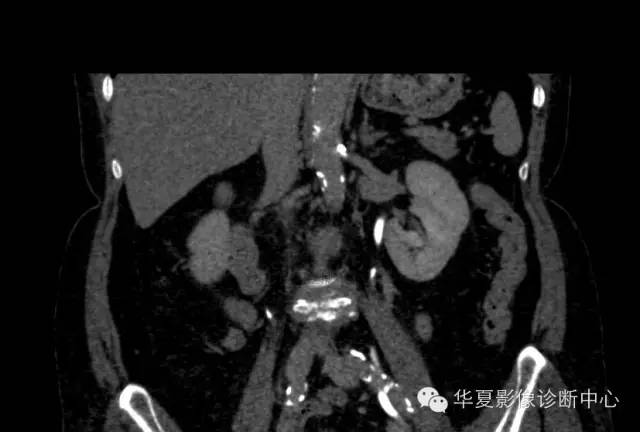 【病例】肾孟癌1例