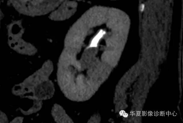 【病例】肾孟癌1例