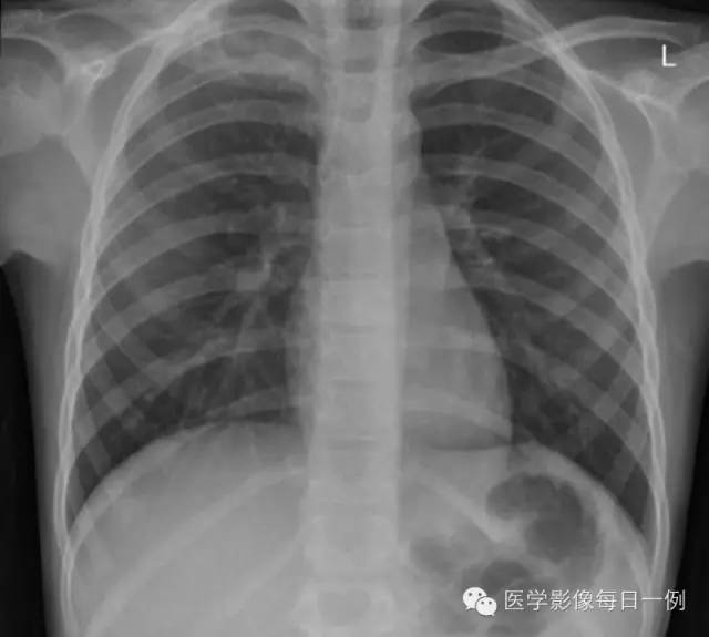 【病例】慢性复发性多灶性骨髓炎1例
