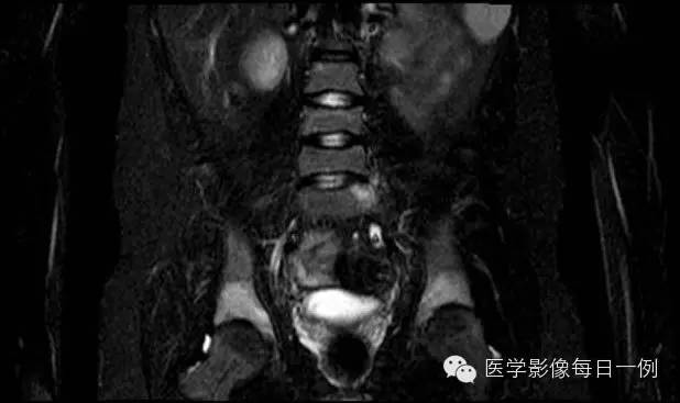 【病例】慢性复发性多灶性骨髓炎1例 【病例】慢性复发性多灶性骨髓炎1例