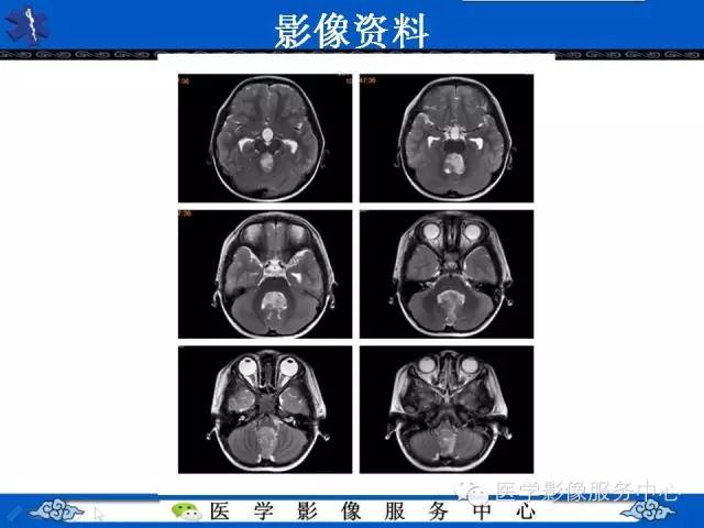【病例】室管膜母细胞瘤1例MR影像表现