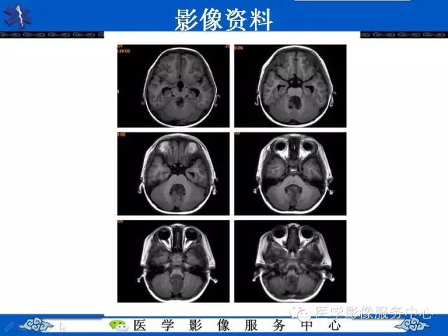 【病例】室管膜母细胞瘤1例MR影像表现