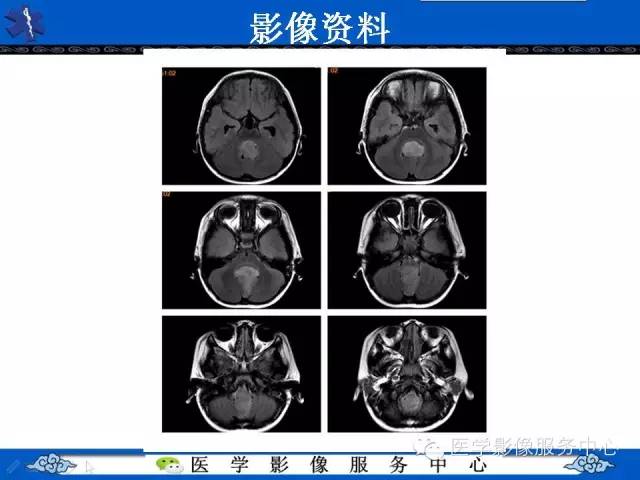 【病例】室管膜母细胞瘤1例MR影像表现