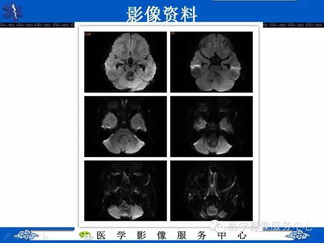 【病例】室管膜母细胞瘤1例MR影像表现