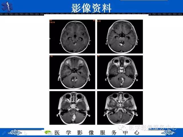 【病例】室管膜母细胞瘤1例MR影像表现