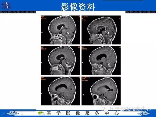 【病例】室管膜母细胞瘤1例MR影像表现