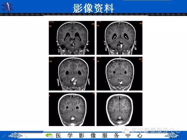 【病例】室管膜母细胞瘤1例MR影像表现