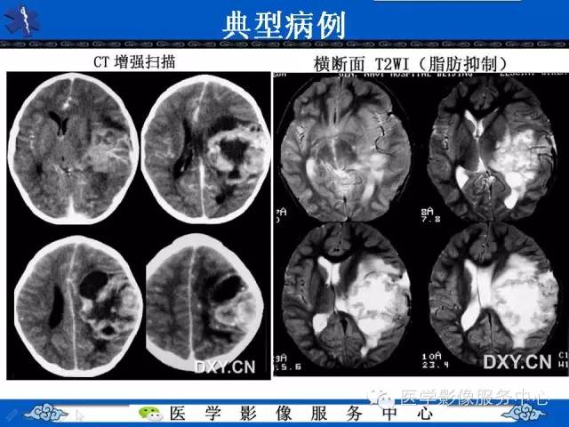 【病例】室管膜母细胞瘤1例MR影像表现