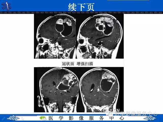 【病例】室管膜母细胞瘤1例MR影像表现