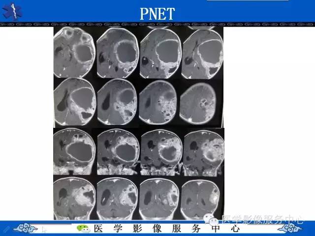 【病例】室管膜母细胞瘤1例MR影像表现