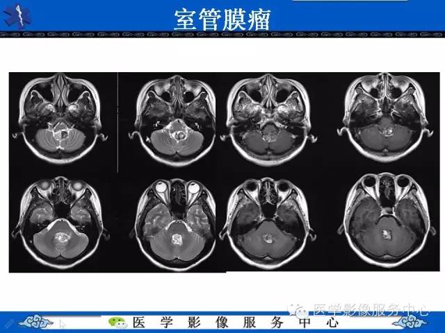 【病例】室管膜母细胞瘤1例MR影像表现