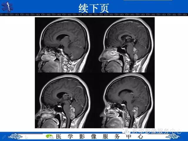 【病例】室管膜母细胞瘤1例MR影像表现