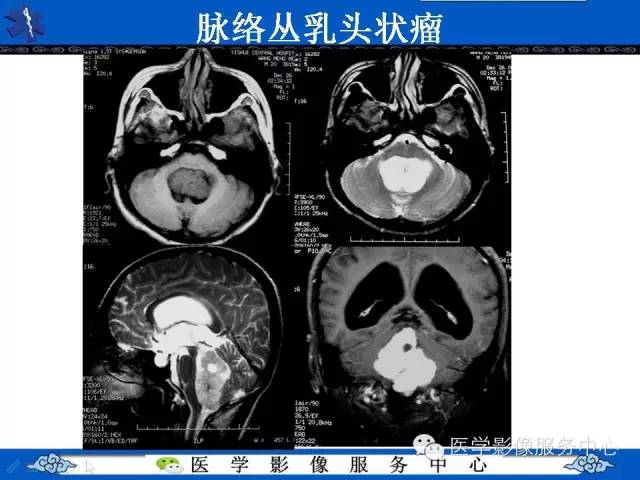 【病例】室管膜母细胞瘤1例MR影像表现