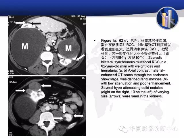 【PPT】RCC罕见影像表现