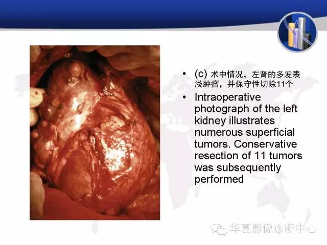 【PPT】RCC罕见影像表现