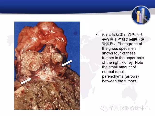 【PPT】RCC罕见影像表现