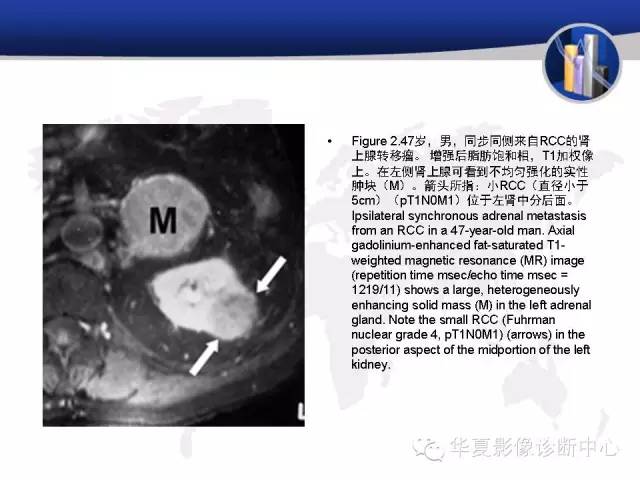 【PPT】RCC罕见影像表现