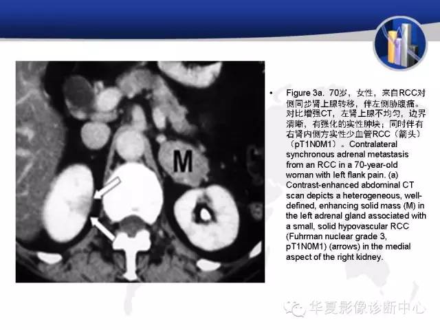 【PPT】RCC罕见影像表现