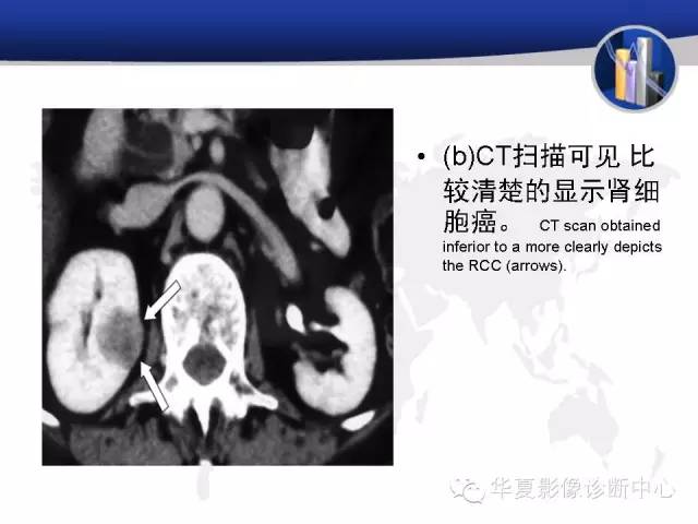 【PPT】RCC罕见影像表现