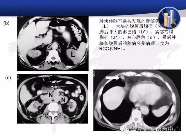 【PPT】RCC罕见影像表现