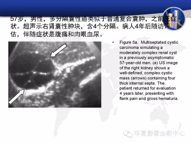 【PPT】RCC罕见影像表现