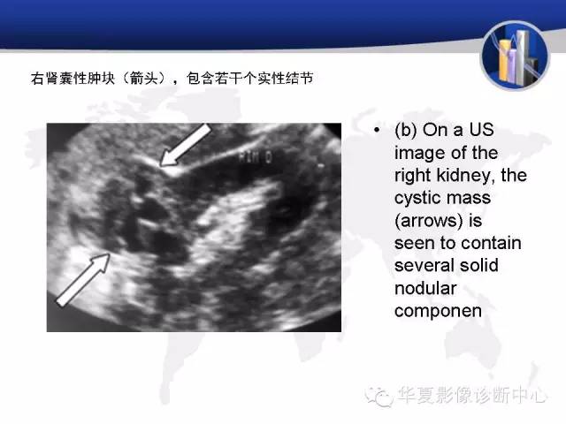 【PPT】RCC罕见影像表现