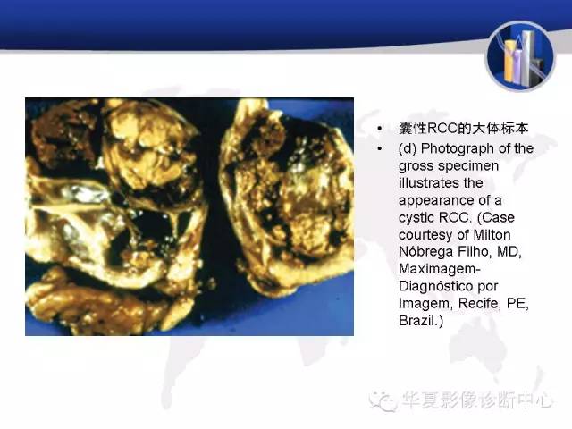 【PPT】RCC罕见影像表现