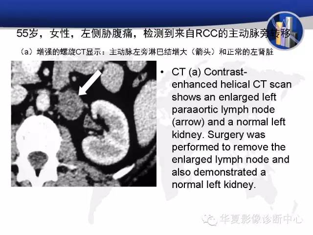 【PPT】RCC罕见影像表现