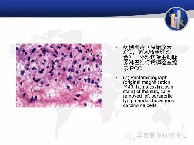【PPT】RCC罕见影像表现