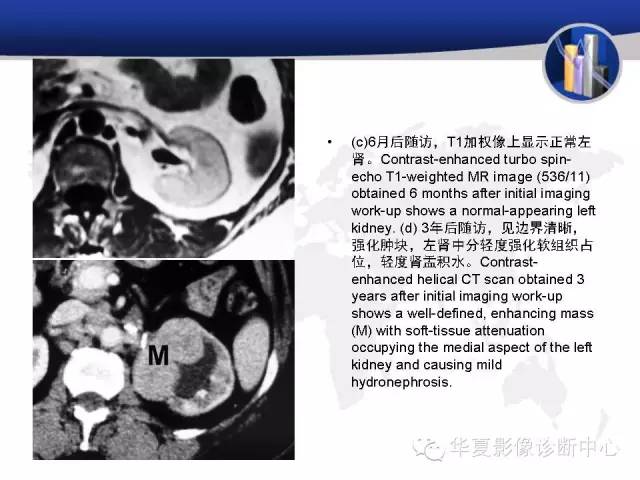 【PPT】RCC罕见影像表现