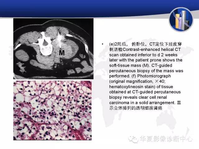 【PPT】RCC罕见影像表现