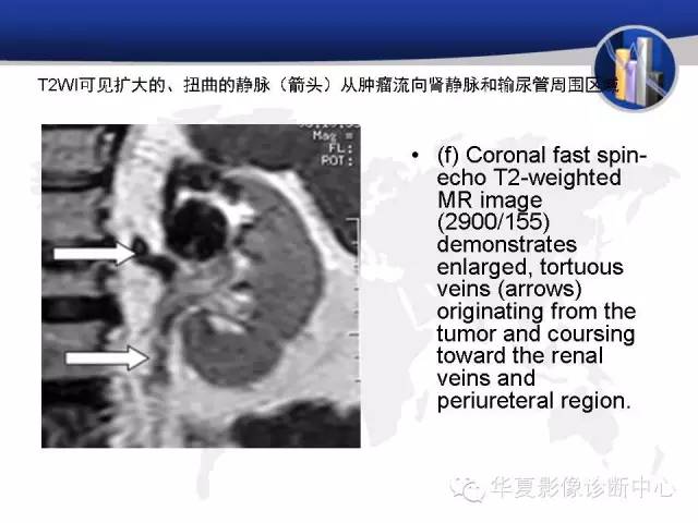 【PPT】RCC罕见影像表现