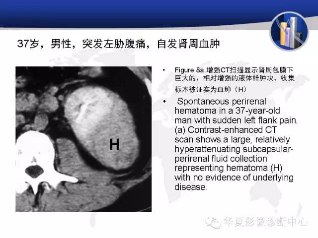 【PPT】RCC罕见影像表现