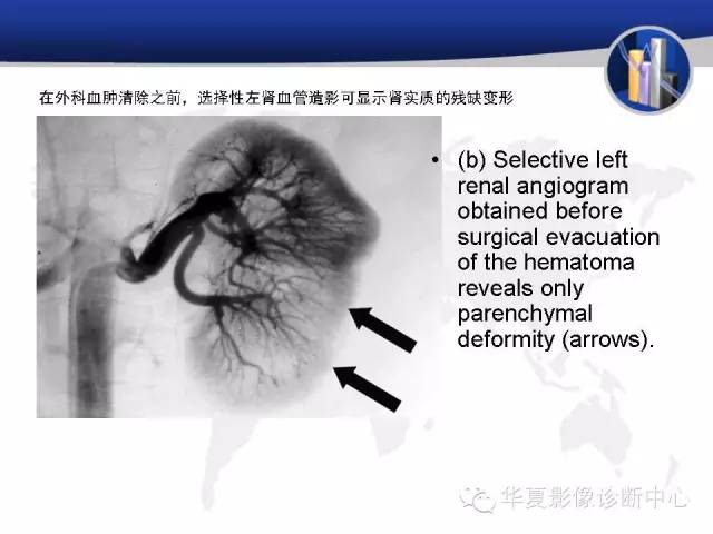【PPT】RCC罕见影像表现