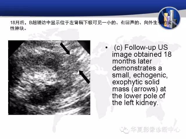 【PPT】RCC罕见影像表现