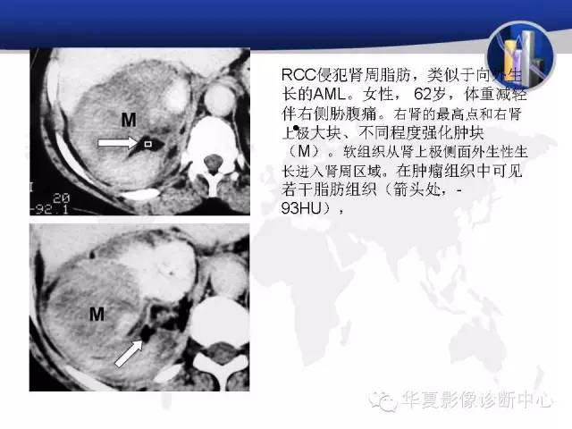 【PPT】RCC罕见影像表现