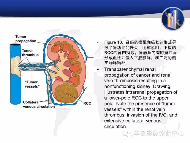 【PPT】RCC罕见影像表现