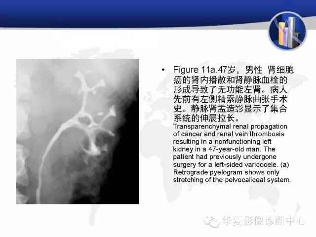 【PPT】RCC罕见影像表现