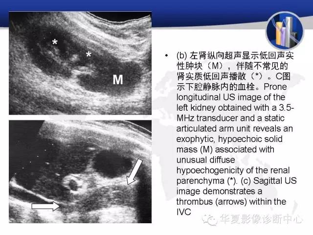 【PPT】RCC罕见影像表现