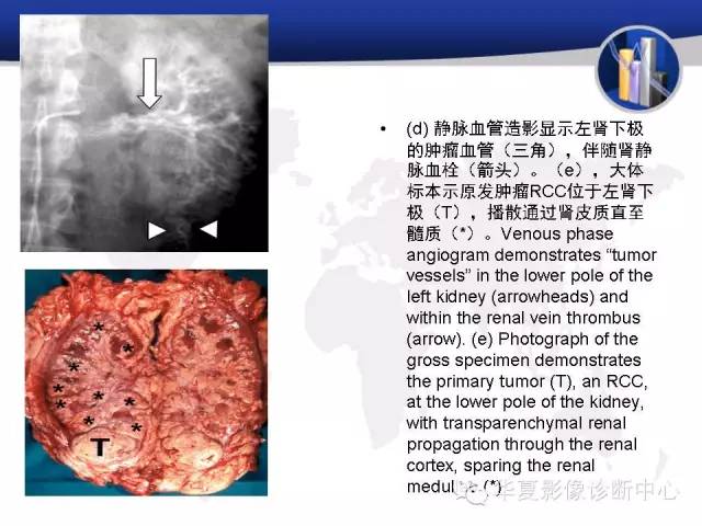 【PPT】RCC罕见影像表现