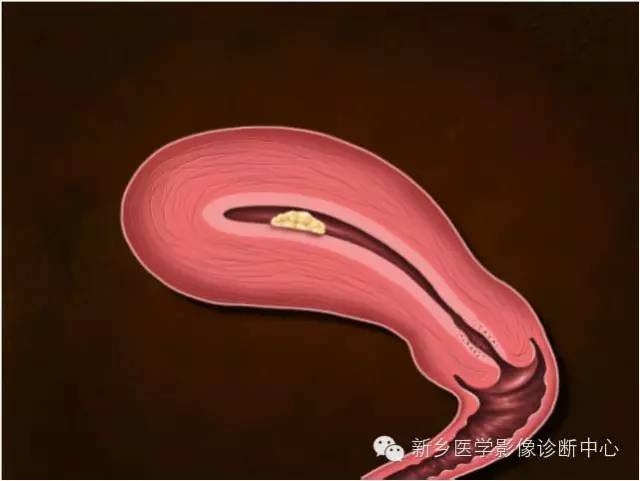 子宫内膜癌磁共振分期及图解