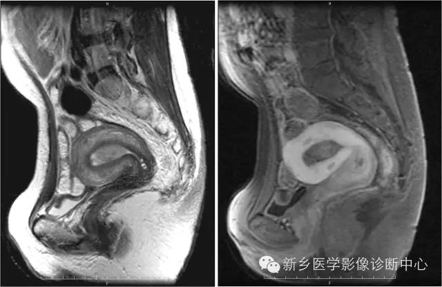 子宫内膜癌磁共振分期及图解
