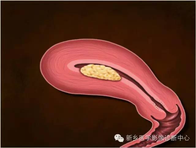 子宫内膜癌磁共振分期及图解