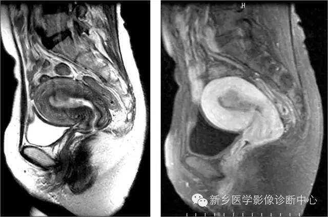 子宫内膜癌磁共振分期及图解