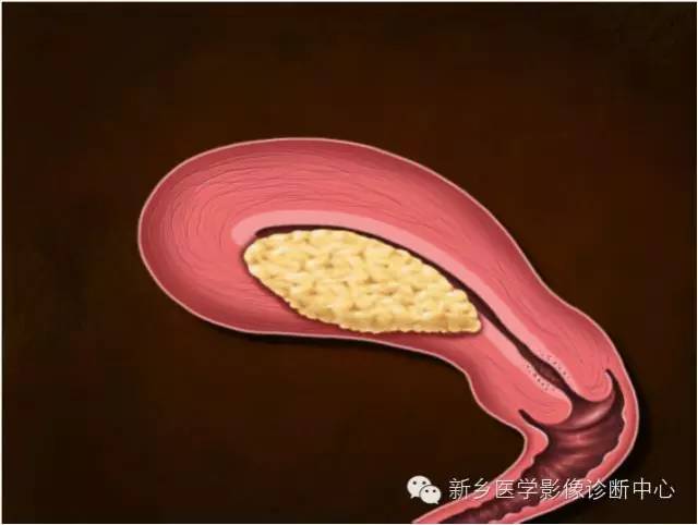 子宫内膜癌磁共振分期及图解