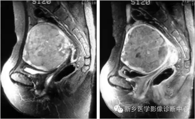 子宫内膜癌磁共振分期及图解