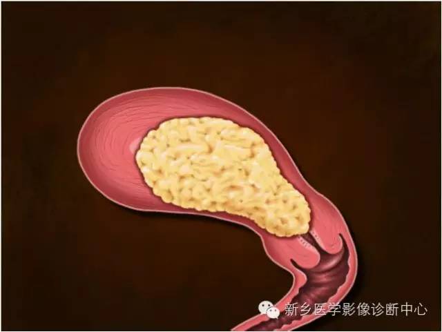子宫内膜癌磁共振分期及图解